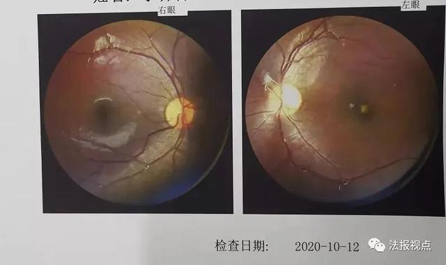 警惕！只照射了几秒钟，9岁的孩子就失去了左眼。  激光笔 激光产品 小军 江西省 激光 玩具 第4张